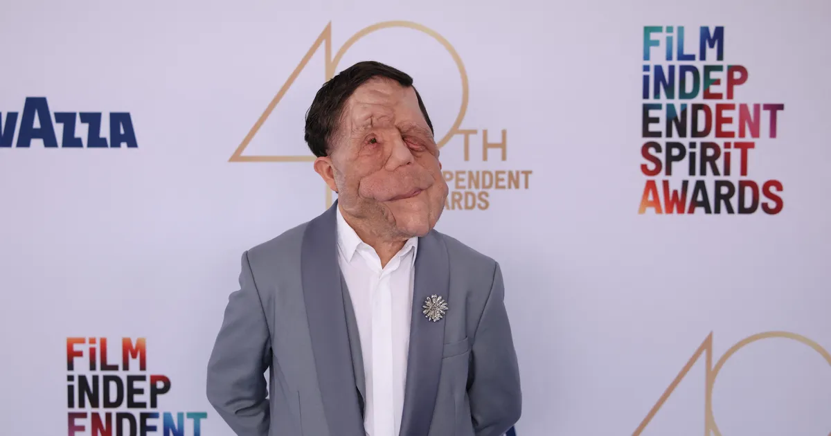 VAATA VIDEOT ⟩ Miks kardab haiguse tõttu «koletiseks» muutunud näitleja tehisaru?