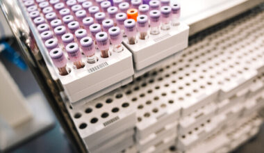 Laboriteenuste piirhinna kärpimine teeb haiglatele muret | Eesti