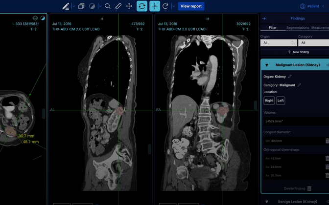 Tehisaru aitab neeruvähki kiiremini avastada | Tervis