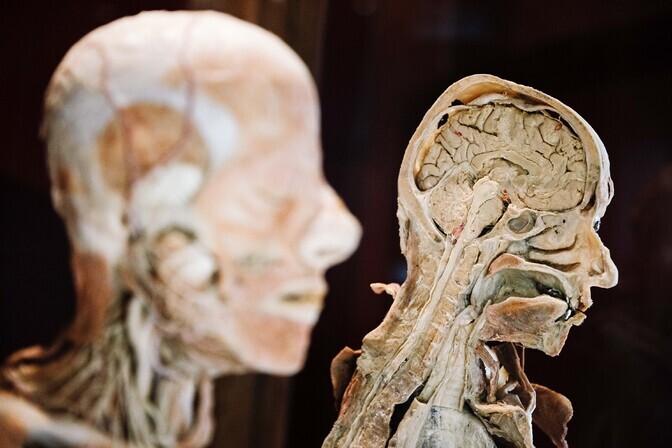 Uuring: multiskleroosi on kahte tüüpi | Tervis