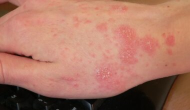 SÜGELEB? ⟩ Eesti koolides on levimas kergesti nakkav parasiit