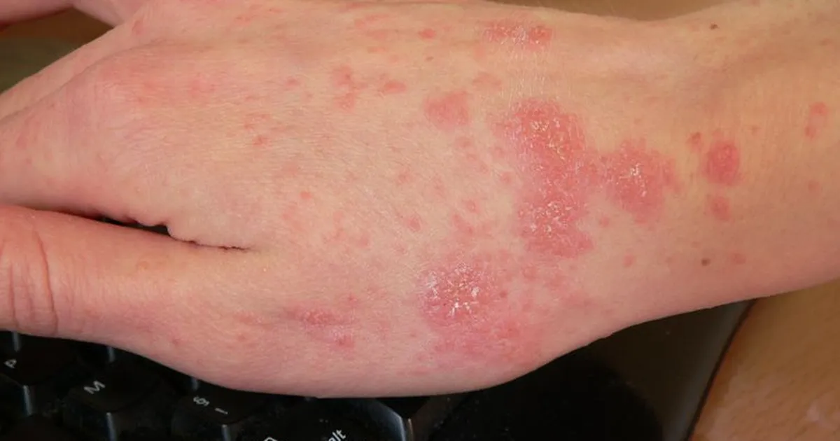 SÜGELEB? ⟩ Eesti koolides on levimas kergesti nakkav parasiit