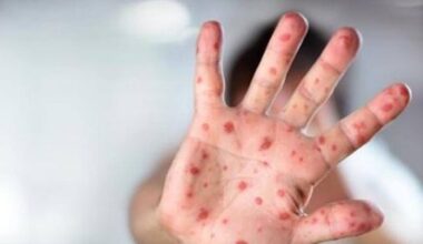 El regreso del sarampión a España pone a Salud en alerta