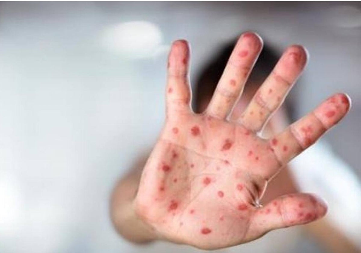 El regreso del sarampión a España pone a Salud en alerta