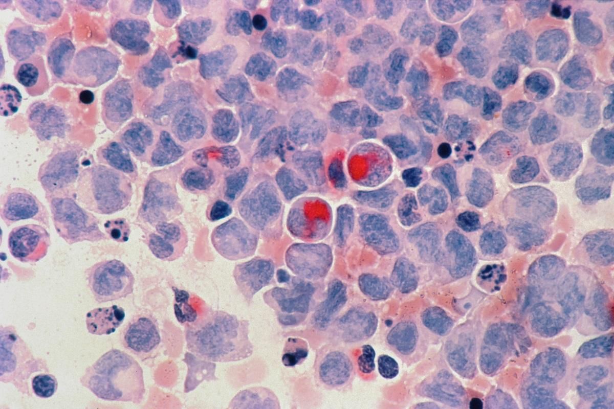 Leucemia mieloide crónica, mieloma y cáncer de colon y recto, entre los que más mejoran.