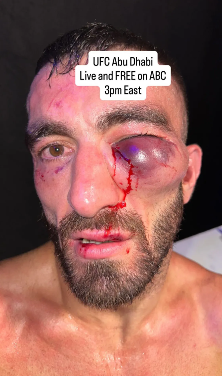 El rostro de Yahya, después de su batalla en UFC Abu Dhabi