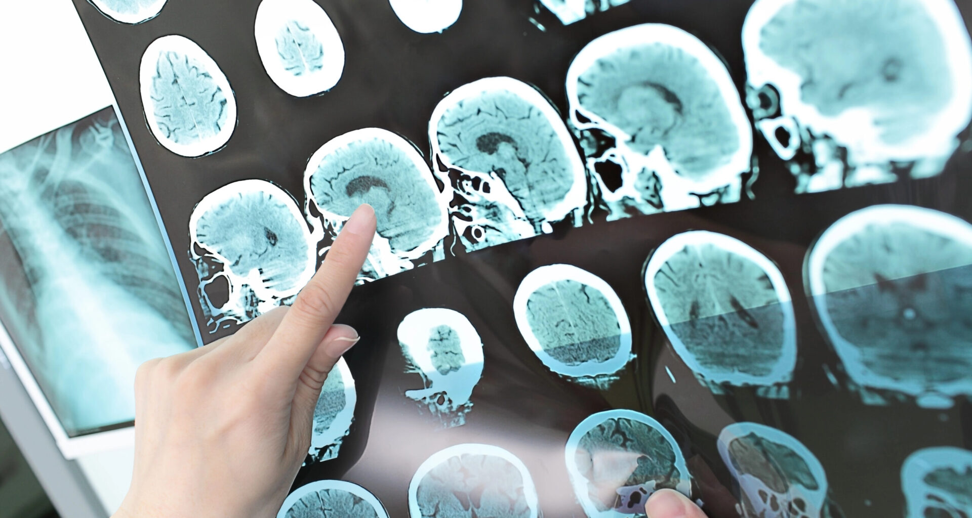 Roche avanza con trontinemab para el Alzheimer temprano