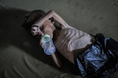 Muhamad Zakariya Ayoub al-Matouq, de apenas año y medio, sufre desnutrición severa y potencialmente mortal. Su peso ha caído de 9 a 6 kilos, y lucha por sobrevivir en una tienda de campaña donde escasean la leche, los alimentos y otros productos básicos.  Fotografía tomada el pasado 21 de julio de 2025.