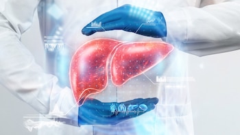 El carcinoma hepatocelular es el