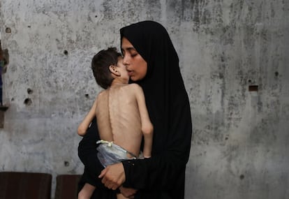 Samah Matar sostiene a su hijo Yousef, que padece una parálisis cerebral y tiene signos de malnutrición. Fotografía tomada el pasado 24 de julio en la Ciudad de Gaza.  