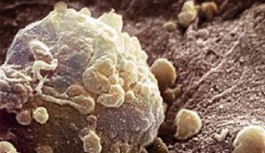 melanoma-opdualag