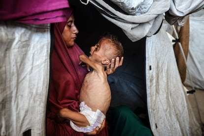 Mohamed sufre una malnutrición severa. 