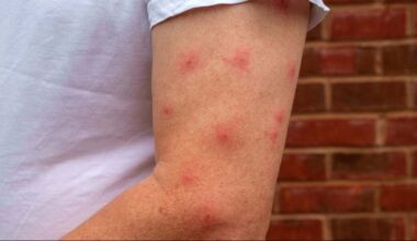 "Las personas con este grupo sanguíneo atraen más a los mosquitos"