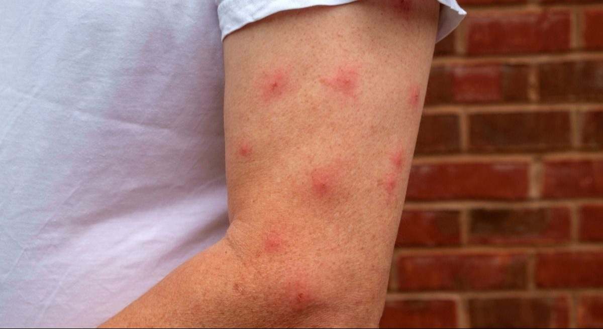 "Las personas con este grupo sanguíneo atraen más a los mosquitos"