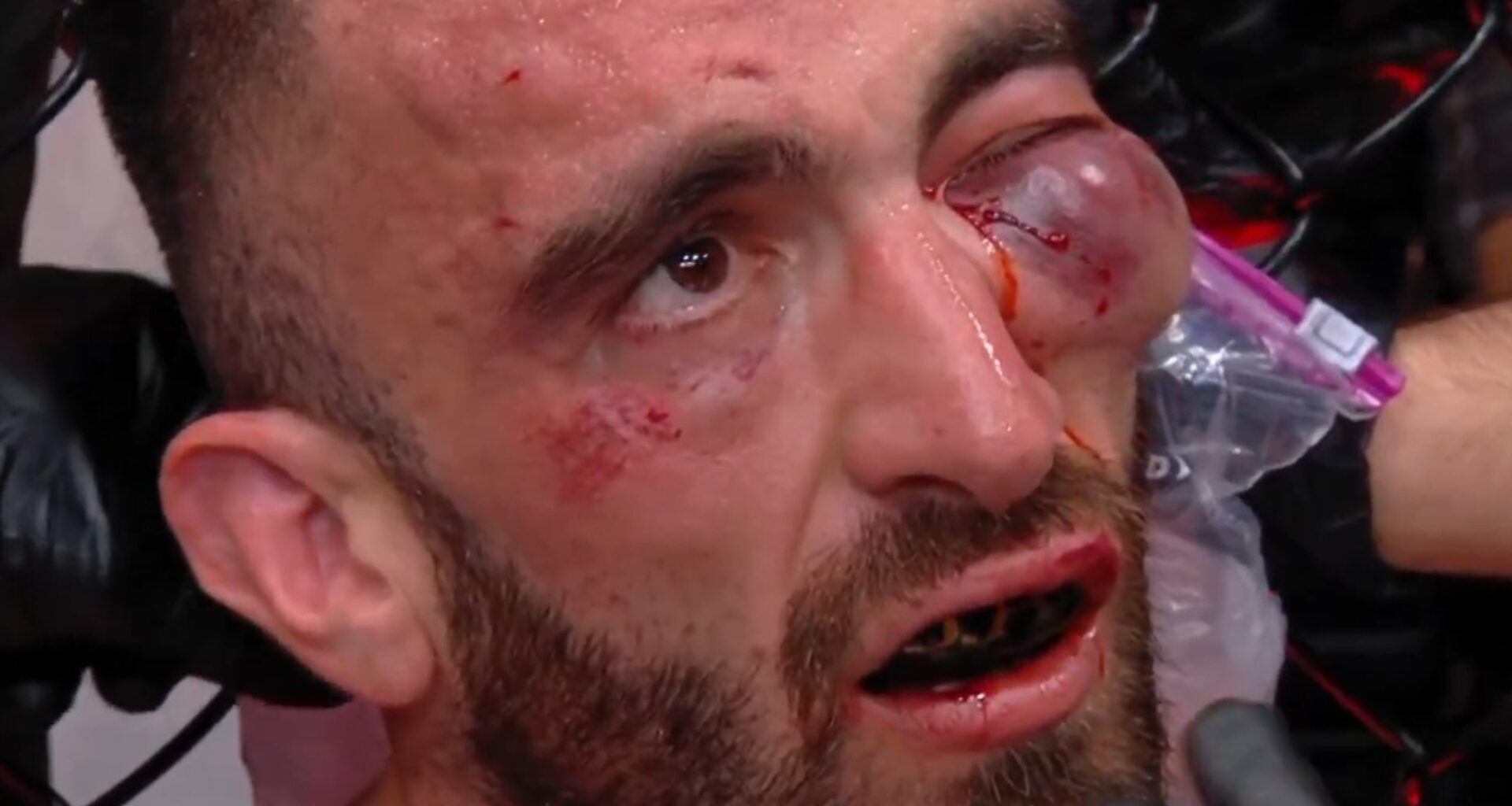 Mohammad Yahya quedó con un ojo a punto de explotar y pararon su pelea con Steven Nguyen