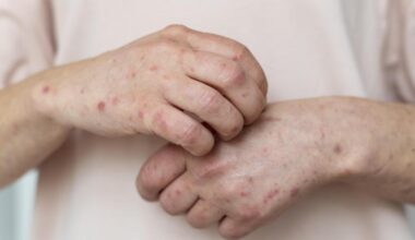 Aumentan un 42% los casos de sarampión en el Estado respecto a 2024