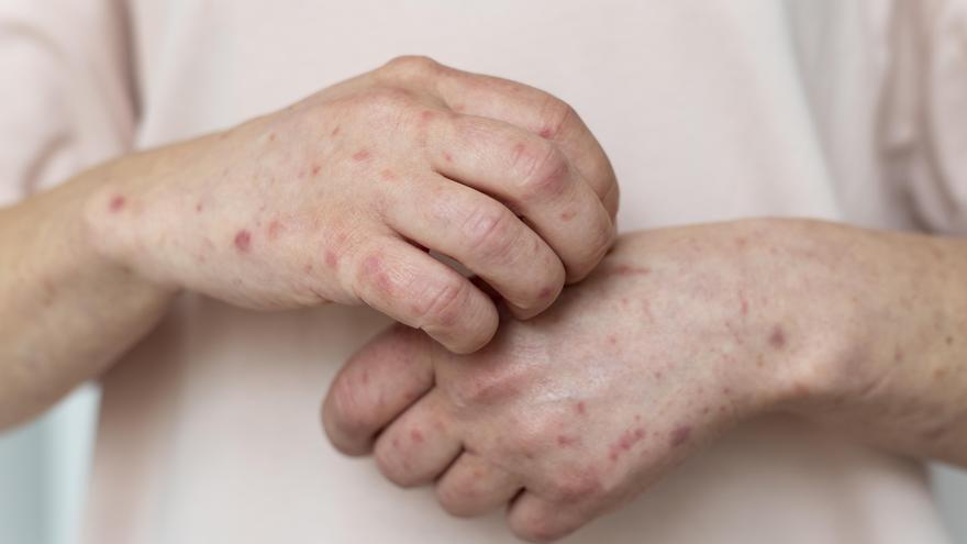 Aumentan un 42% los casos de sarampión en el Estado respecto a 2024