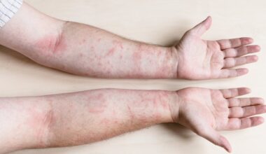 La dermatitis atópica podría ser una puerta de entrada a enfermedades autoinmunes, según un nuevo estudio