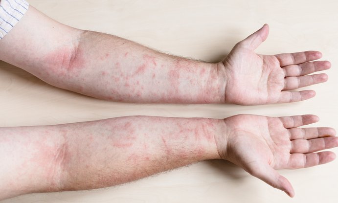 La dermatitis atópica podría ser una puerta de entrada a enfermedades autoinmunes, según un nuevo estudio