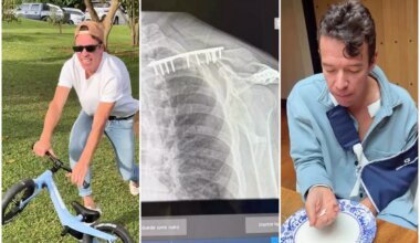 Increíble accidente de Rigoberto Urán en bicicleta de su hija: Lo operaron por fractura de clavícula - MARCA