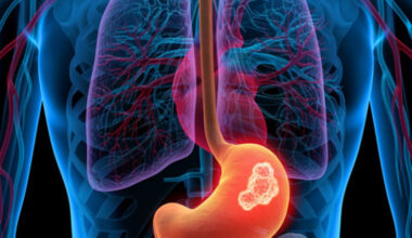 Aumento de cáncer digestivo en menores de 50 años: causas, riesgos y prevención