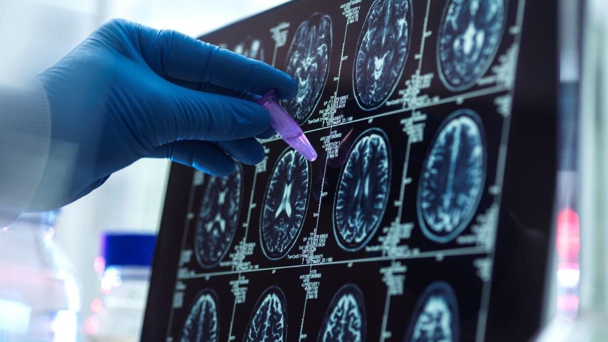 Investigadores del CSIC desarrollan una escala genética más precisa para mejorar la detección precoz del alzhéimer