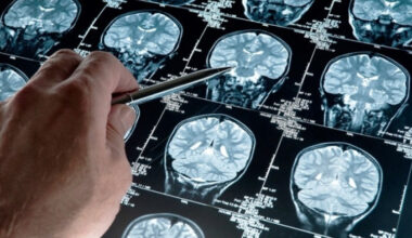 Hallazgo científico: el litio natural del cerebro podría ser clave contra el alzhéimer