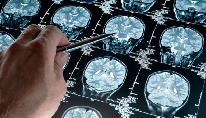 Hallazgo científico: el litio natural del cerebro podría ser clave contra el alzhéimer
