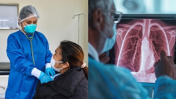 La tuberculosis pulmonar sigue poniendo