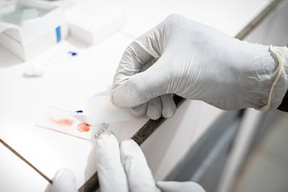 El biólogo Fakouma Camara prepara una muestra de sangre para examinarla bajo el microscopio. Así determinará si hay parásitos responsables de la malaria. 