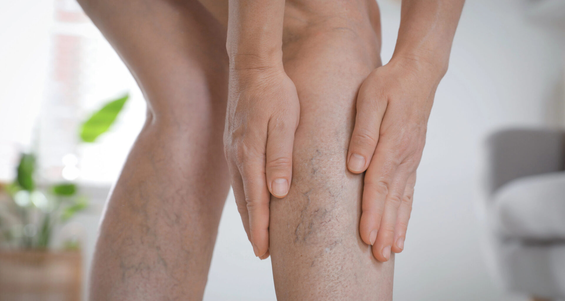 Las consultas por patologías venosas repuntan hasta un 30% tras el verano