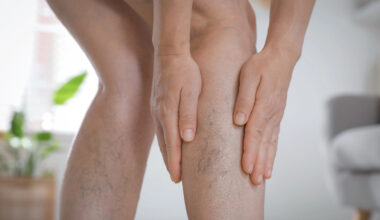 Las consultas por patologías venosas repuntan hasta un 30% tras el verano
