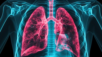 La enfermedad pulmonar obstructiva crónica