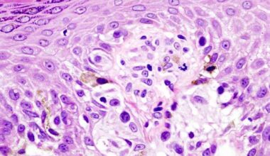 Melanoma