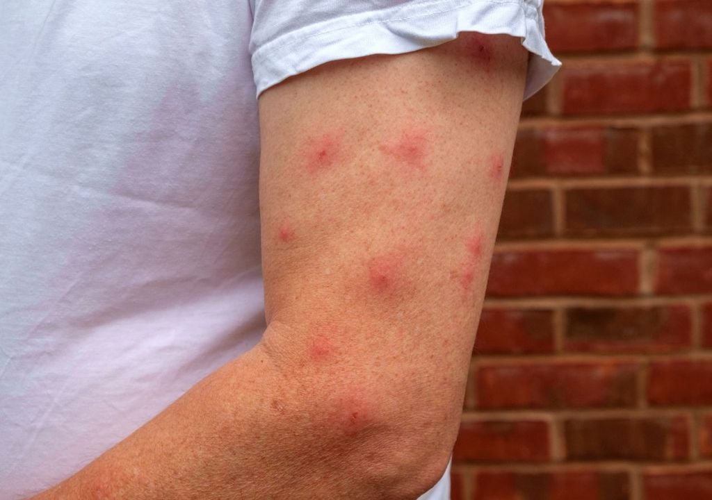 Picaduras de mosquito