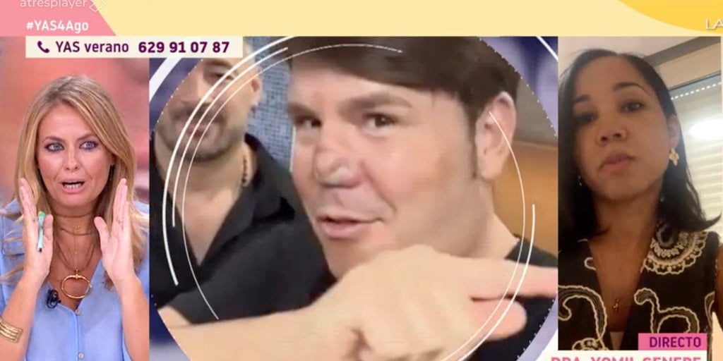 Experta en medicina estética aclara para qué es el comentado apósito que luce Lucas en la nariz