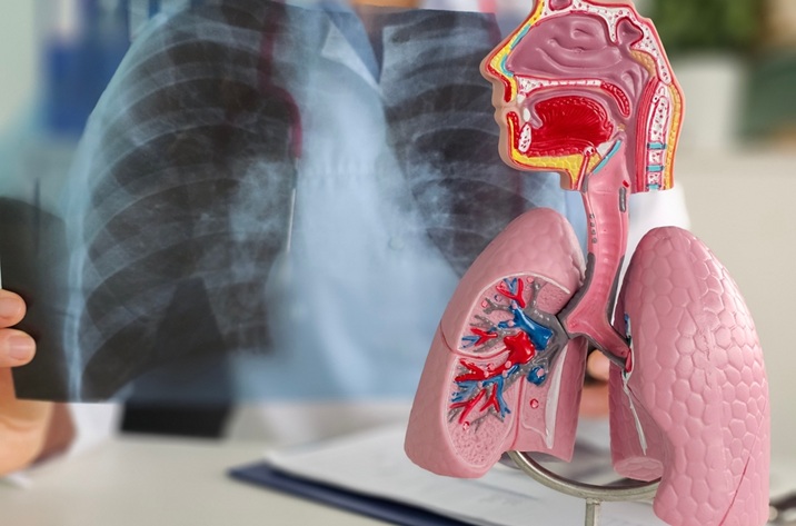 Educación sanitaria y cribado sistemático, claves para revertir el infradiagnóstico de la EPOC en AP