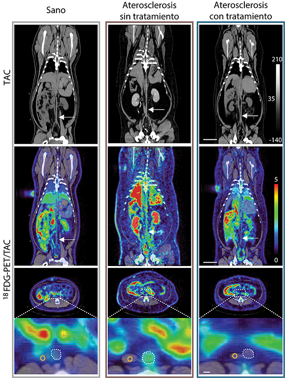 Una técnica de imagen usada en cáncer mejora el seguimiento y tratamiento de la aterosclerosis