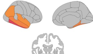 Un estudio de la Universidad de Sevilla prueba que la actividad física ayuda a frenar el deterioro cognitivo del párkinson