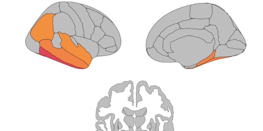 Un estudio de la Universidad de Sevilla prueba que la actividad física ayuda a frenar el deterioro cognitivo del párkinson