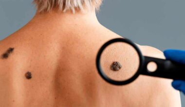 Cómo tratar las verrugas para eliminarlas y evitar que se extiendan por el cuerpo