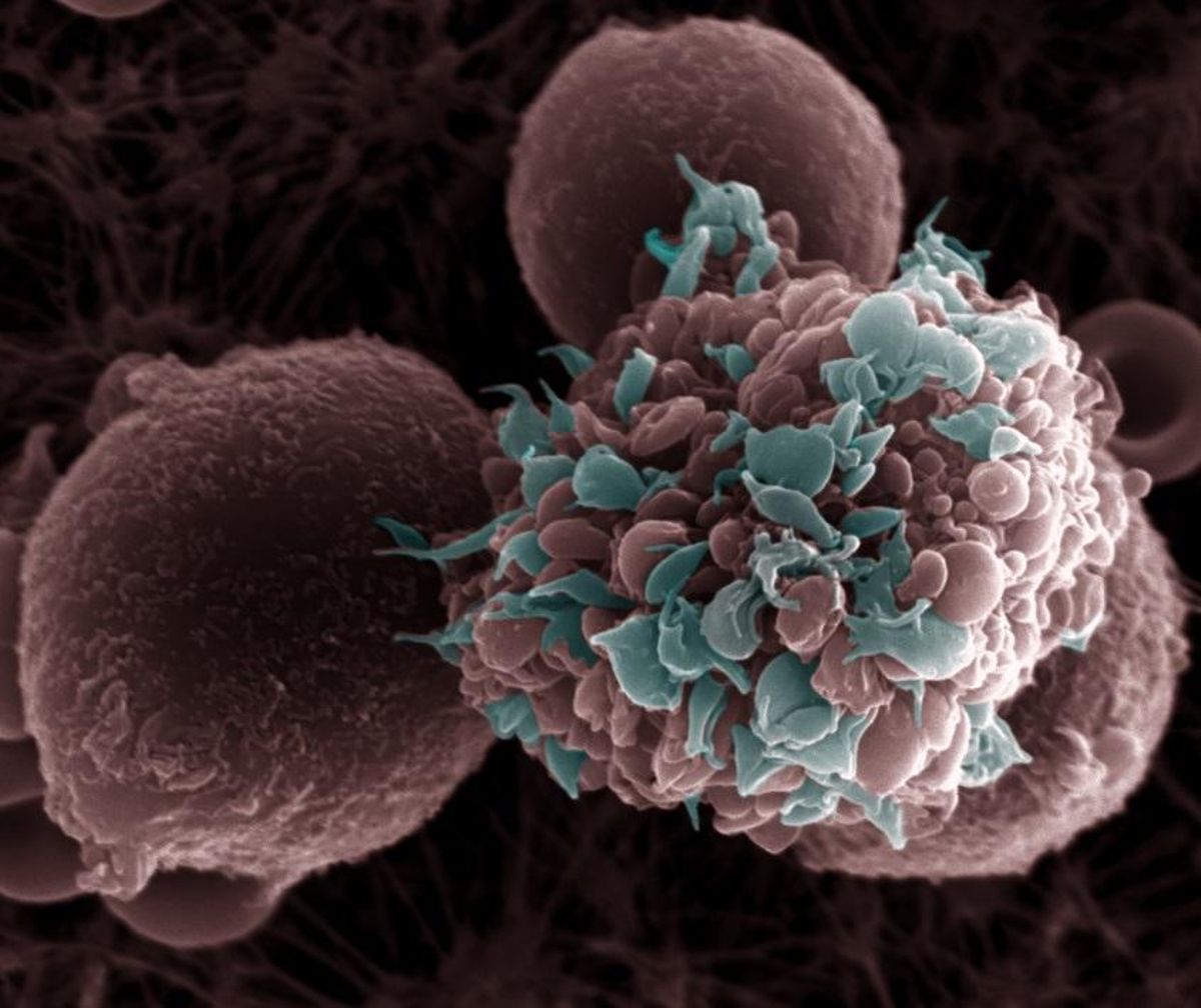 Un estudio en ratones prueba que una dieta grasa favorece la metástasis del cáncer de mama