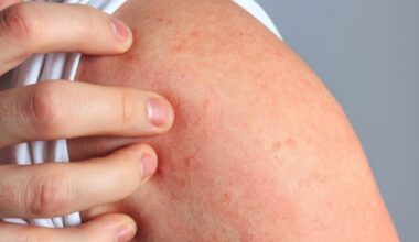 Día Mundial de la Dermatitis Atópica: qué es, por qué aparece y cómo se trata