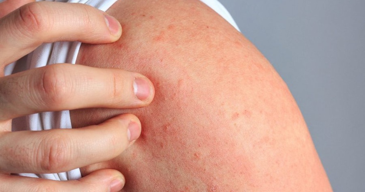 Día Mundial de la Dermatitis Atópica: qué es, por qué aparece y cómo se trata