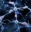 Acumulaciones de la proteína beta-amiloide (color rosado), características del alzheimer, entre neuronas