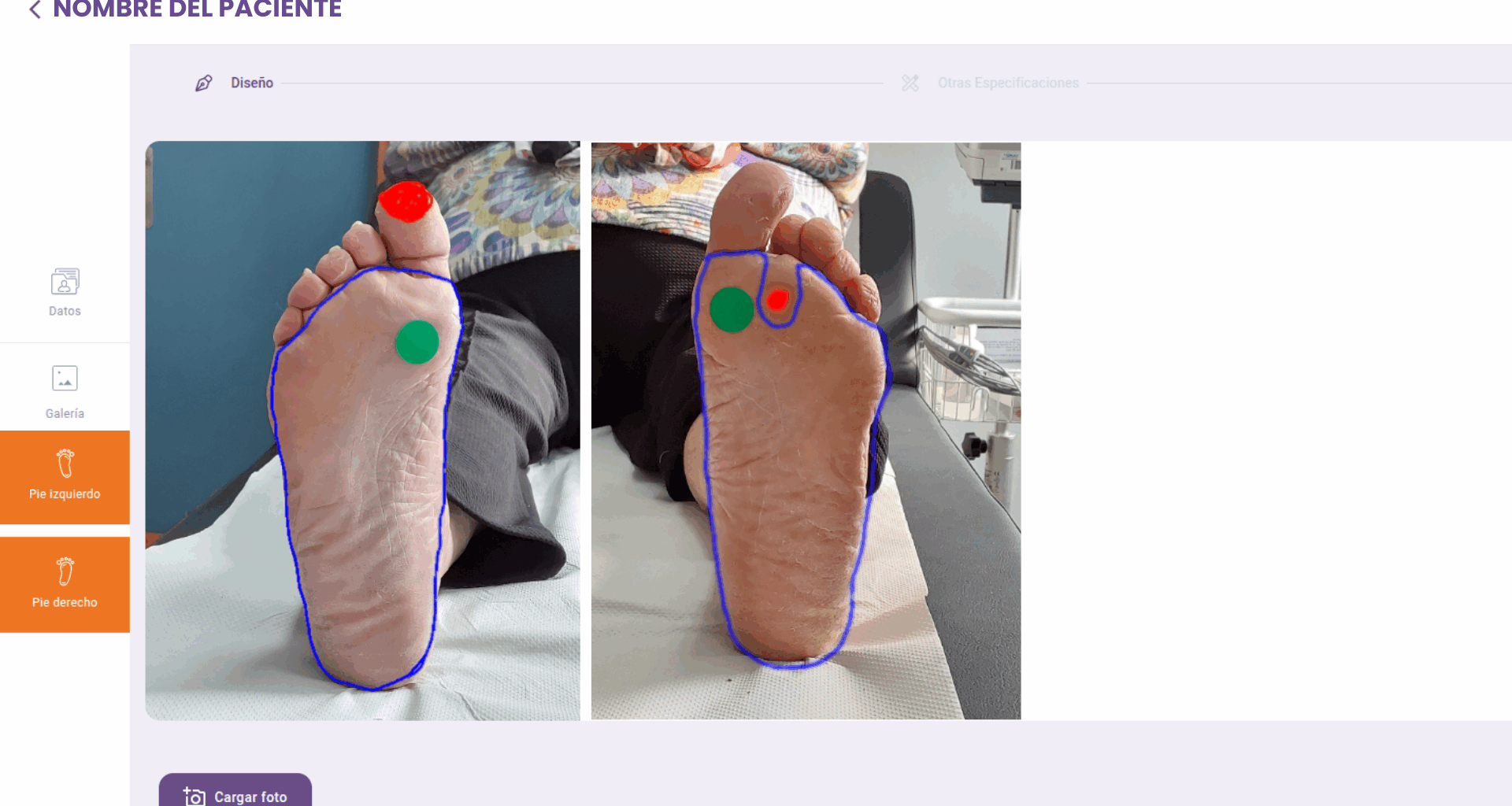 Una app con visión artificial facilita el diagnóstico y seguimiento del pie diabético desde Atención Primaria