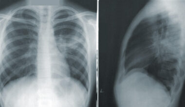Descubren por qué una mutación en el gen implicado en cáncer produce fibrosis pulmonar