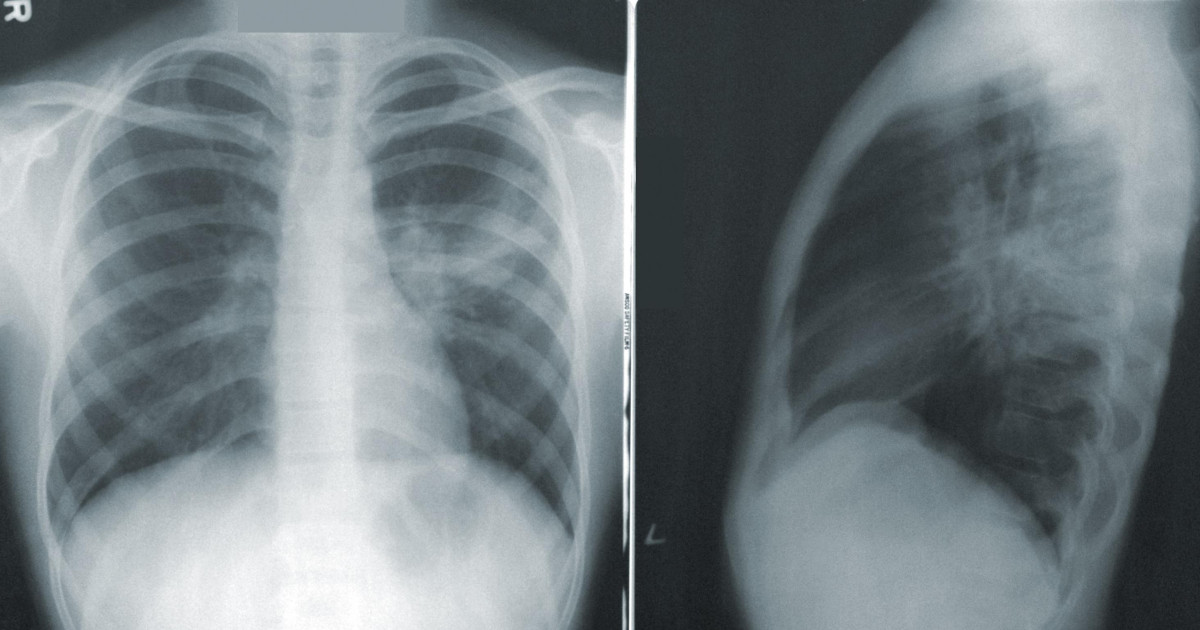 Descubren por qué una mutación en el gen implicado en cáncer produce fibrosis pulmonar