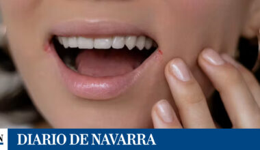 Descubren un nuevo antiviral contra el herpes simple que vence la resistencia a los tratamientos actuales