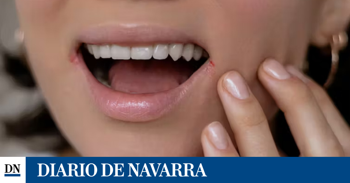 Descubren un nuevo antiviral contra el herpes simple que vence la resistencia a los tratamientos actuales